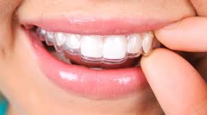 Aligneurs transparents posés sur les dents