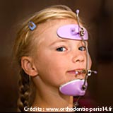 Masque de Delaire, appareil orthopédique extra-oral