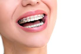 Appareil multiattache Damon collé sur les dents